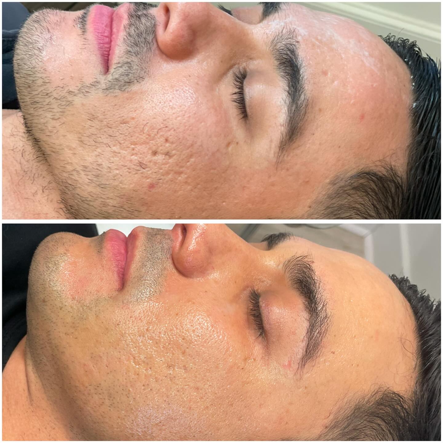 PRP Microneedling Georgetown tx